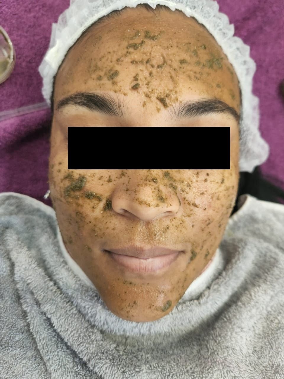 Facial skin treatment in progress at CarenM